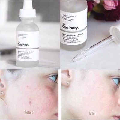 Serum The Ordinary Niacinamide 10% Và Zinc 1%