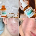 Tinh chất serum Balance Niacinamide 15% Active Formula Blemish