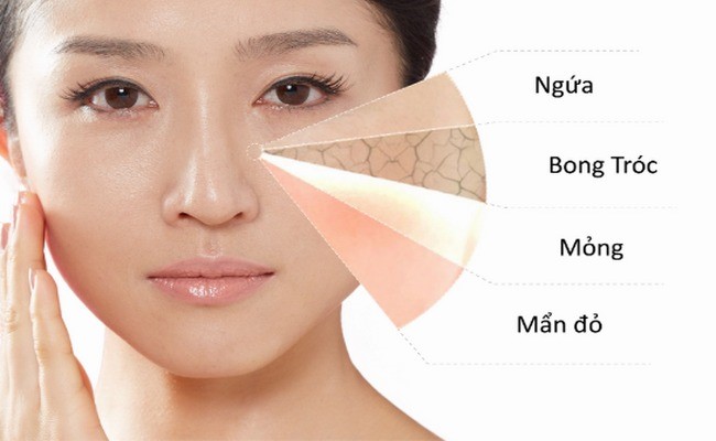 sữa rửa mặt cho da mụn nhạy cảm