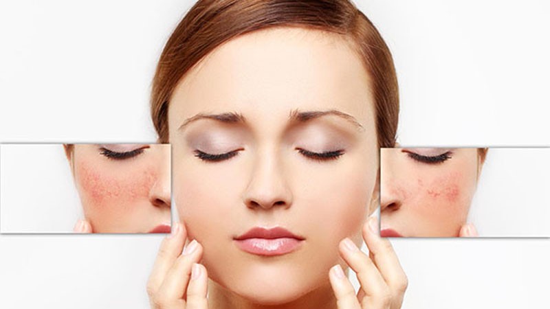 sữa rửa mặt cho da mụn nhạy cảm