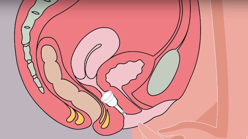 cốc nguyệt san dùng để làm gì